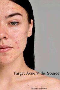Oily skin solutions for acne-prone skin with excess oil and clogged pores