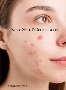 clinically recognized types of acne explained in the smart acne repair protocol