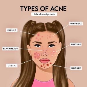 6 clinically recognized types of acne classified by skin science