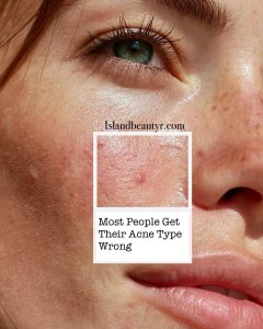 common acne types most people misidentify without clinical guidance