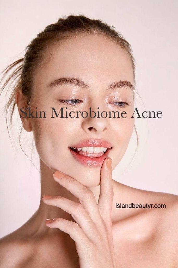 close up of acne prone skin showing inflammation caused by skin microbiome acne imbalance and damaged skin barrier