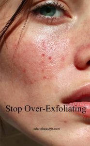 damaged skin barrier contributing to skin microbiome acne flare-ups