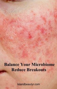 skin microbiome balance to reduce inflammatory acne