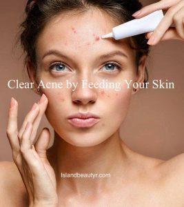 prebiotic acne treatments for acne-prone skin microbiome balance