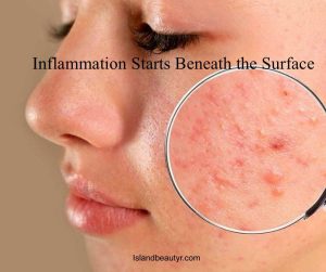 skin inflammation triggered by microbiome imbalance